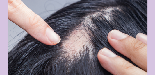 Alopécie, trous et chutes de cheveux sur cheveux texturés...comment y remédier ?