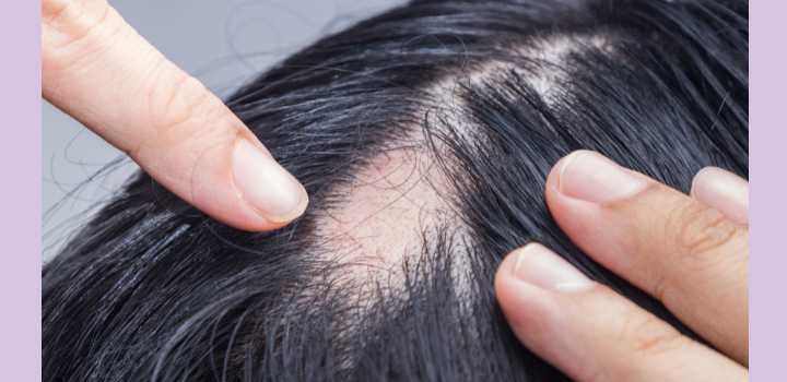 Alopécie, trous et chutes de cheveux sur cheveux texturés...comment y remédier ? Les Confiantes