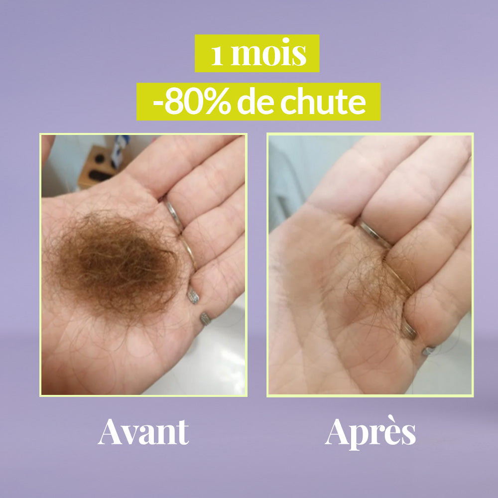 Dermaroller croissance cheveux - Comble les trous et ralentit l'alopécie